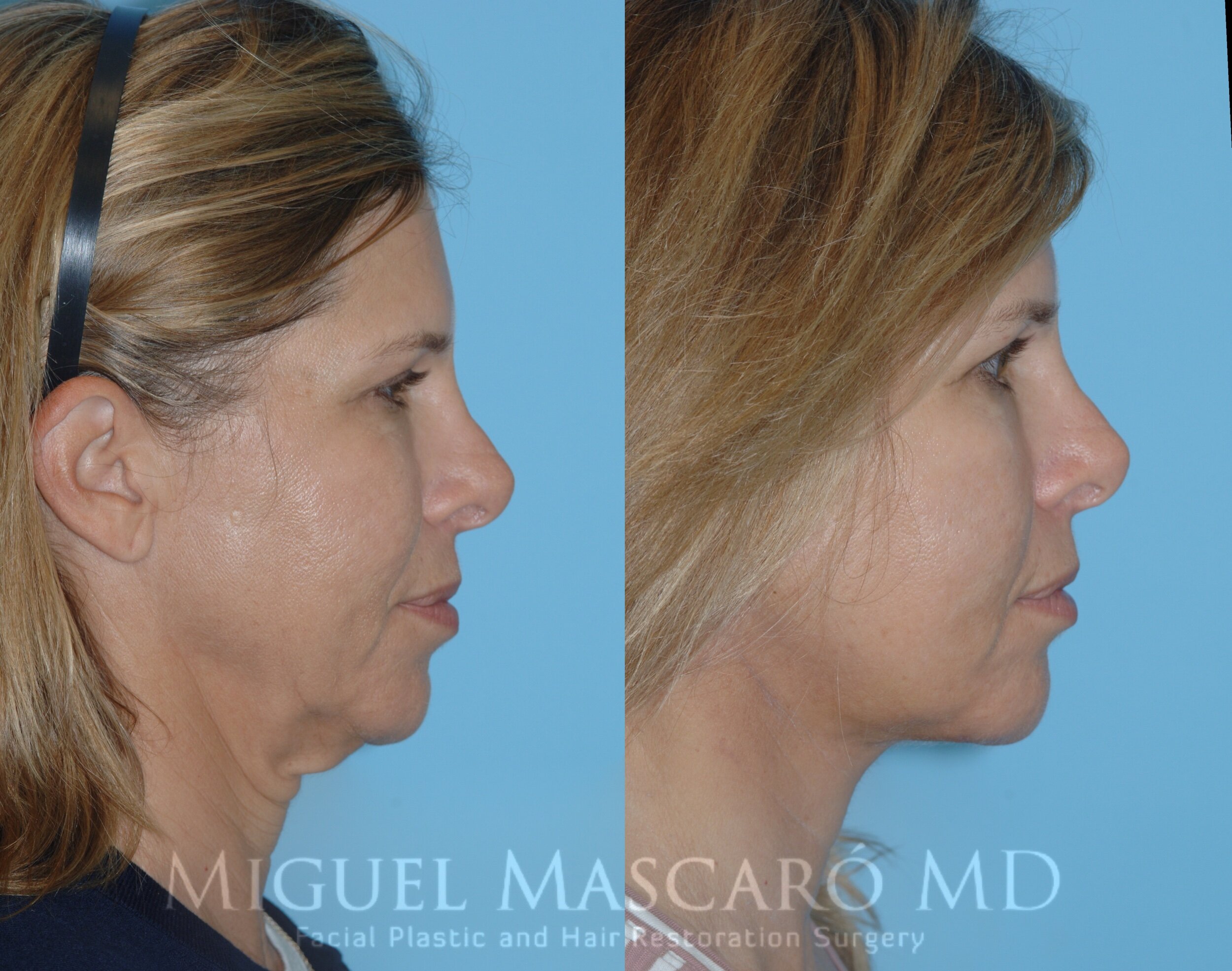  Submentoplasty - isolated surgical neck lift with no incision in front of the ears   