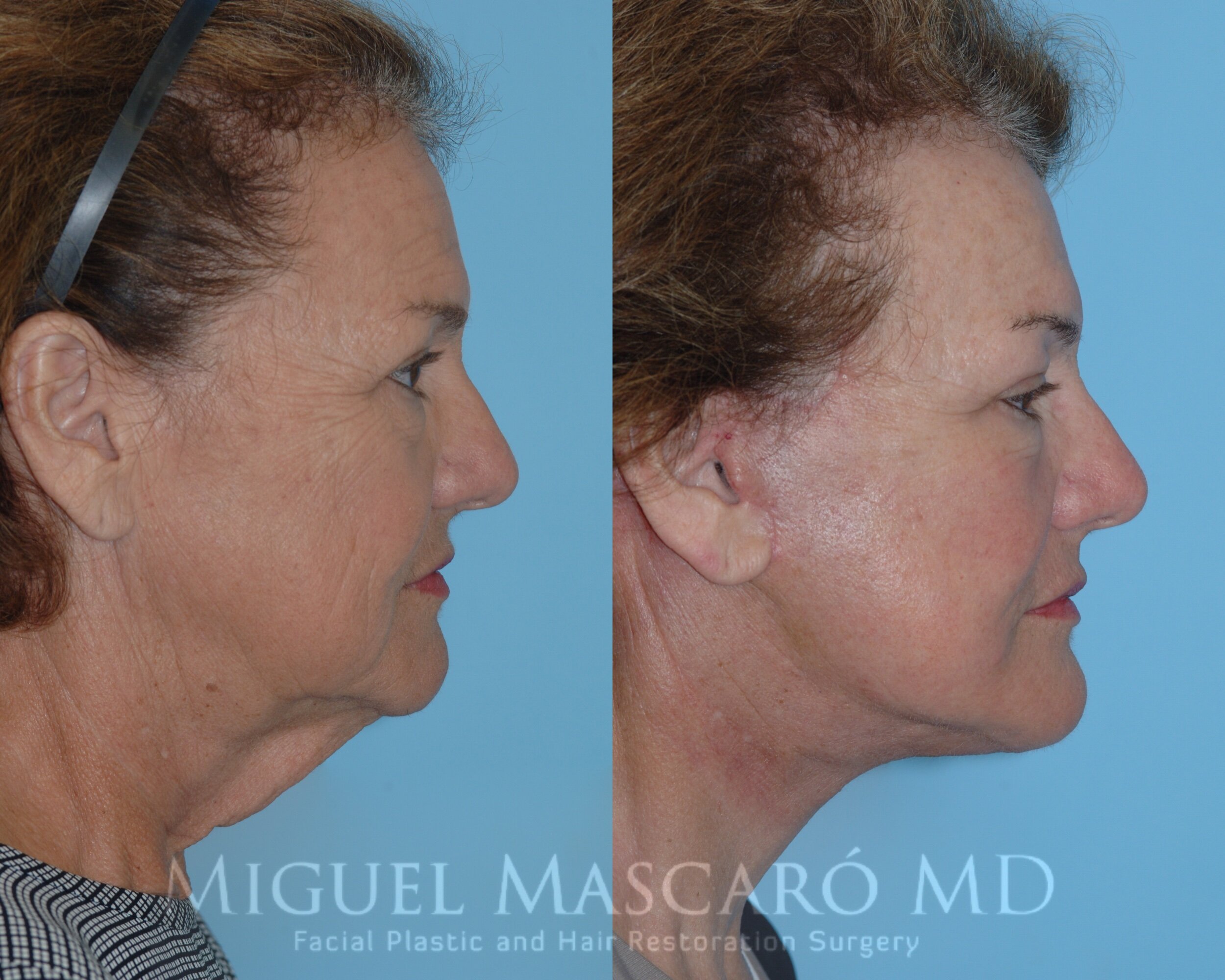  Deep plane face and neck lift  