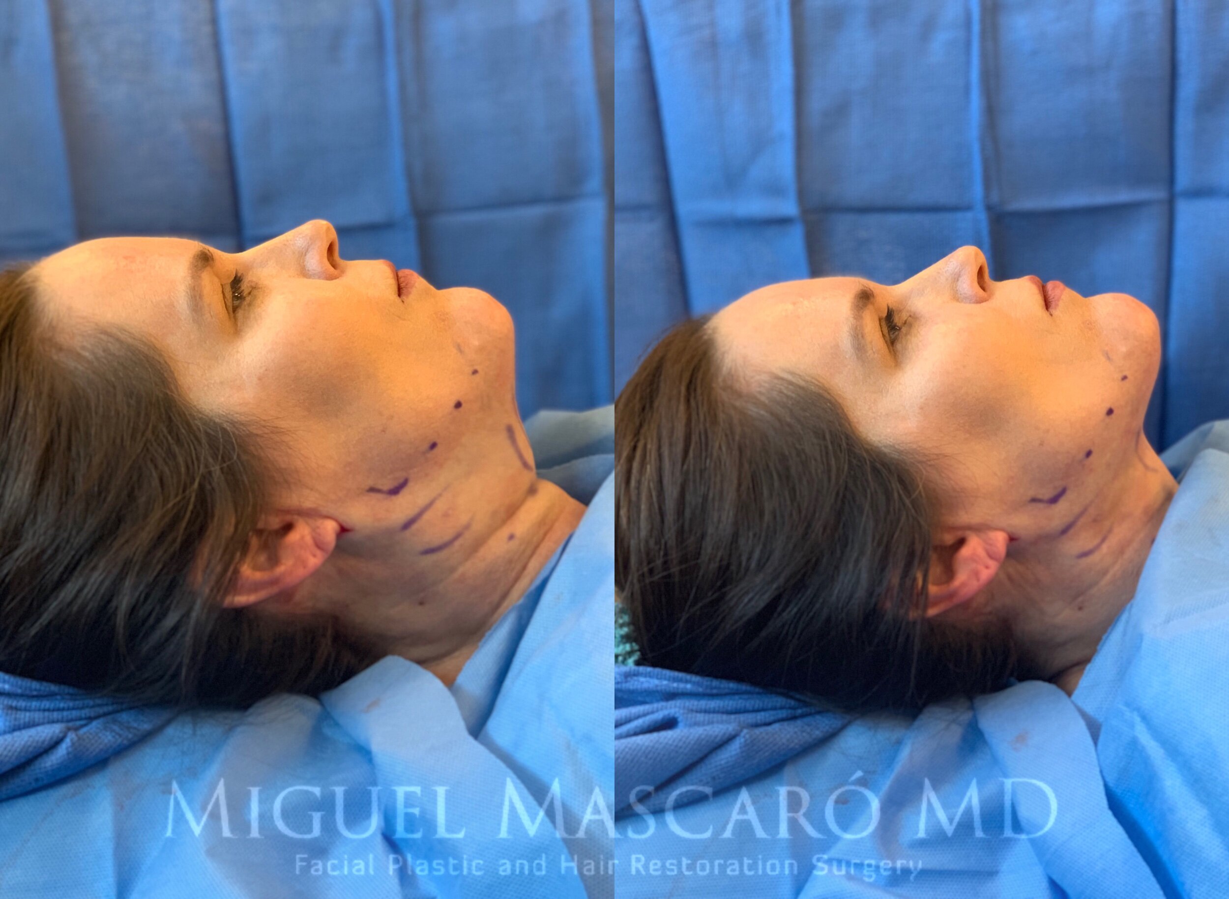  ThermiRF for minimally invasive skin tightening and submental liposuction    