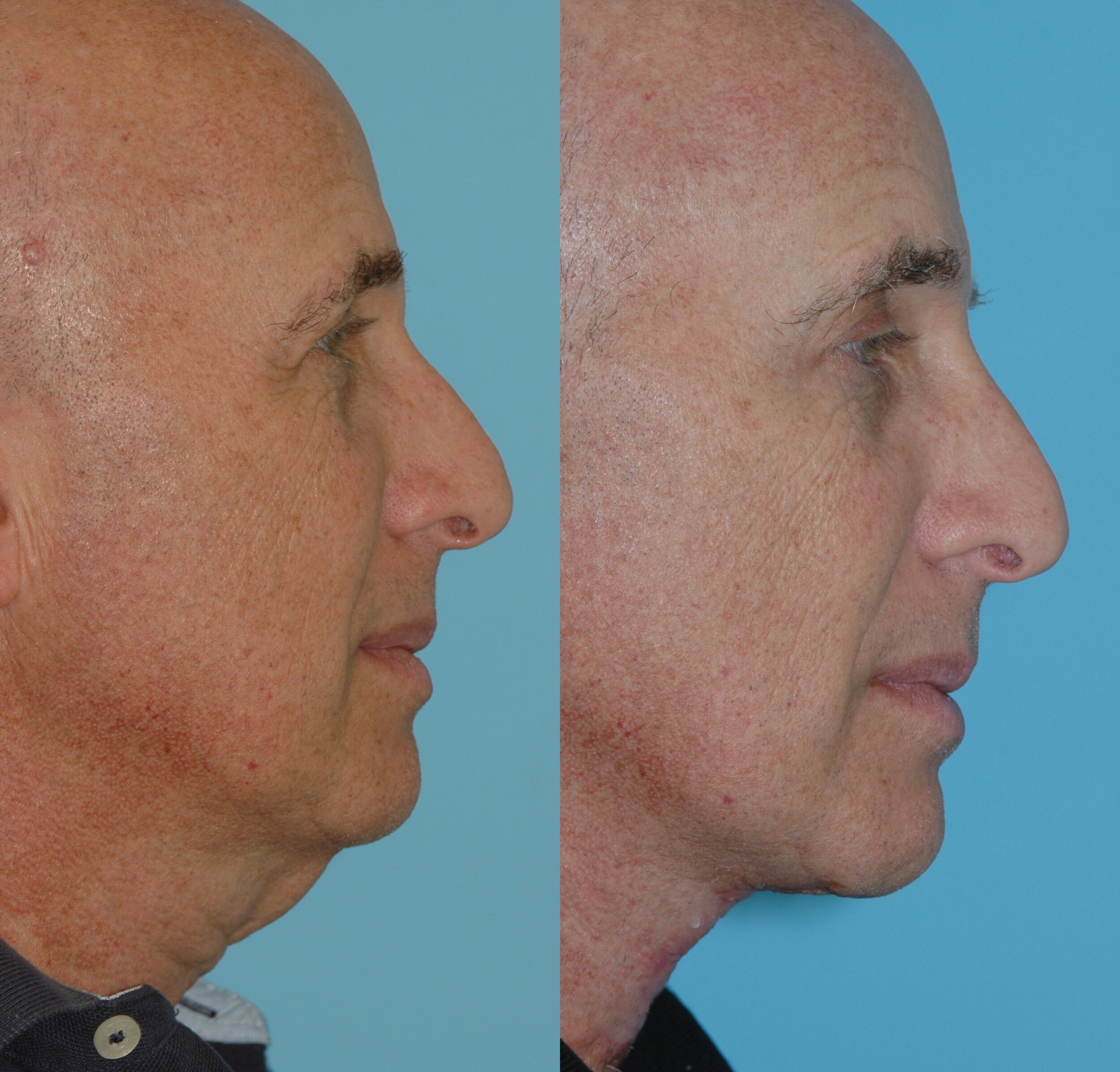  Direct Neck Lift for men 