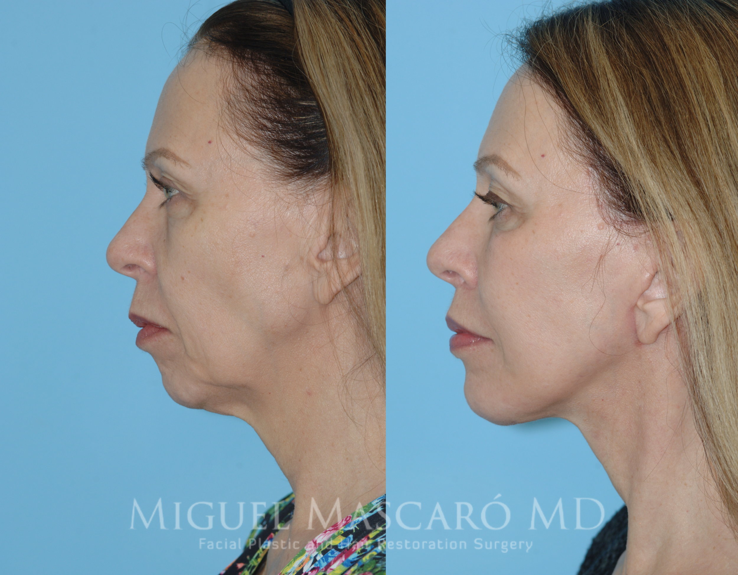  Deep plane face and neck lift with chin implant    