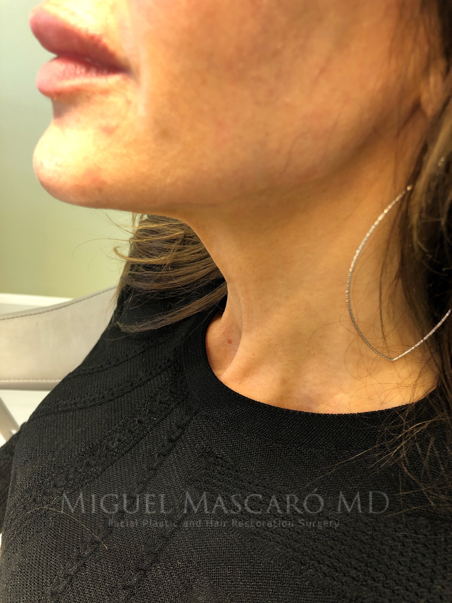  Submentoplasty - isolated surgical neck lift with no incision in front of the ears - 2 weeks out.   