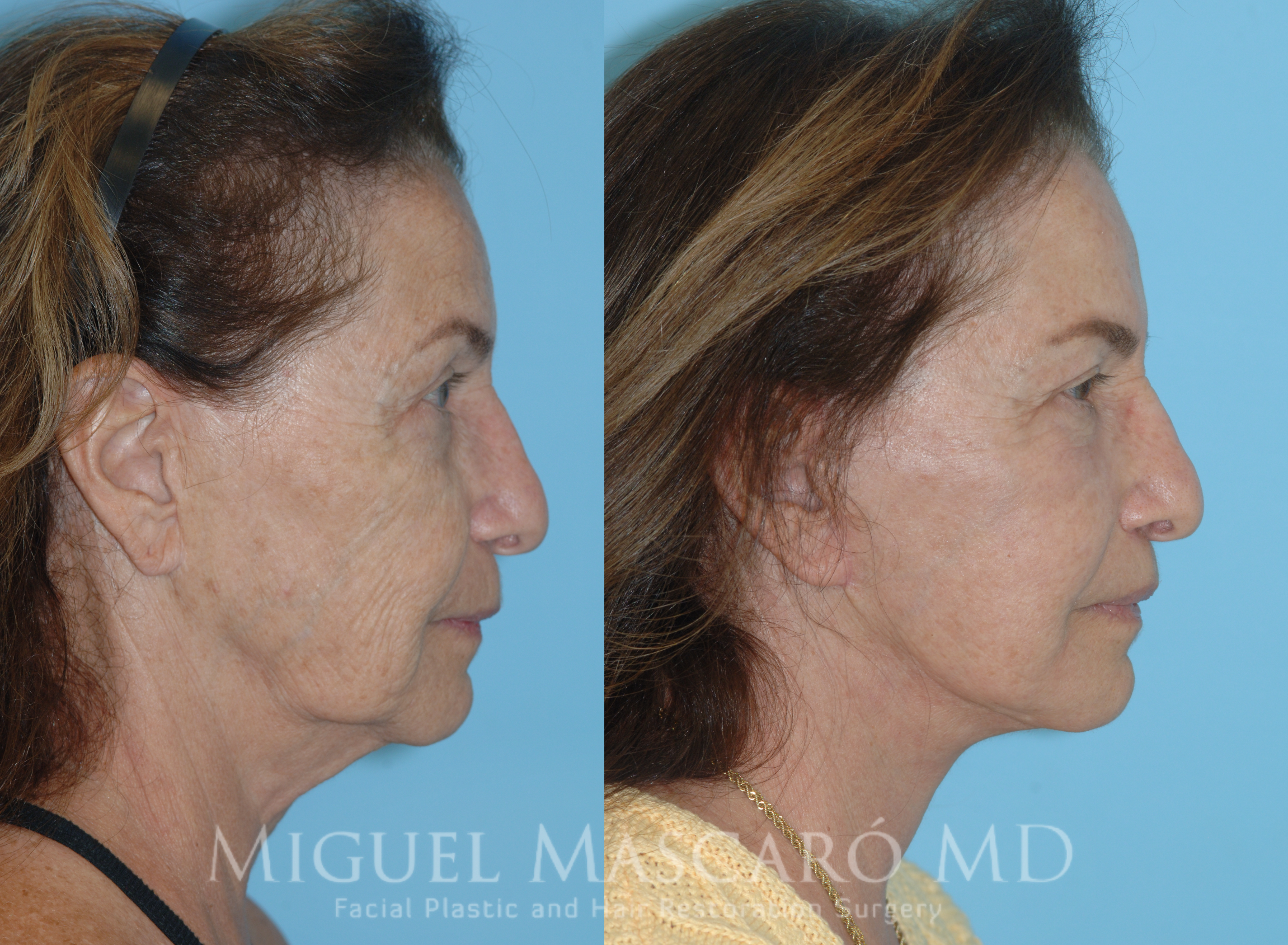  Deep plane face and neck lift   