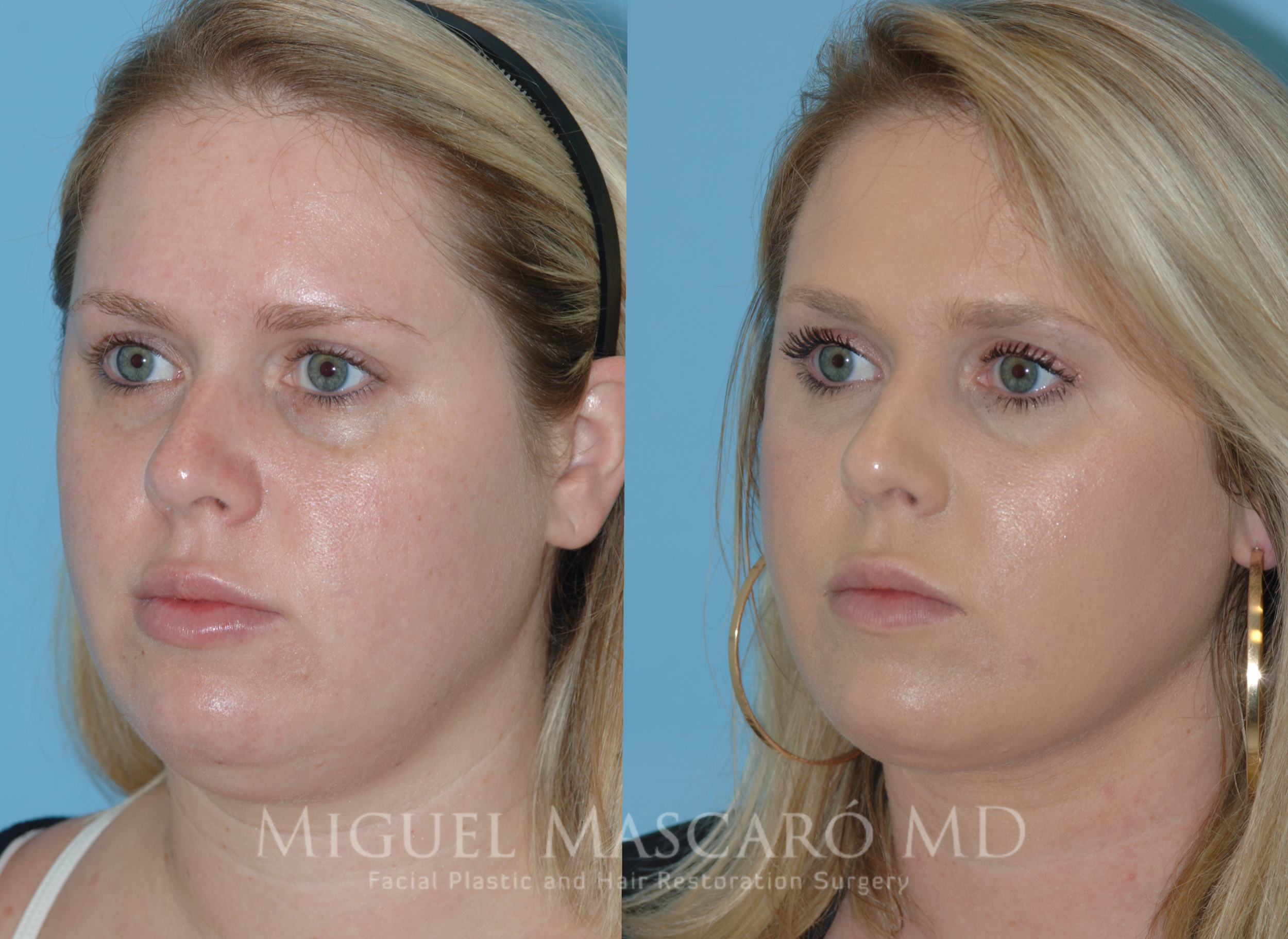  ThermiRF for minimally invasive skin tightening and submental liposuction   