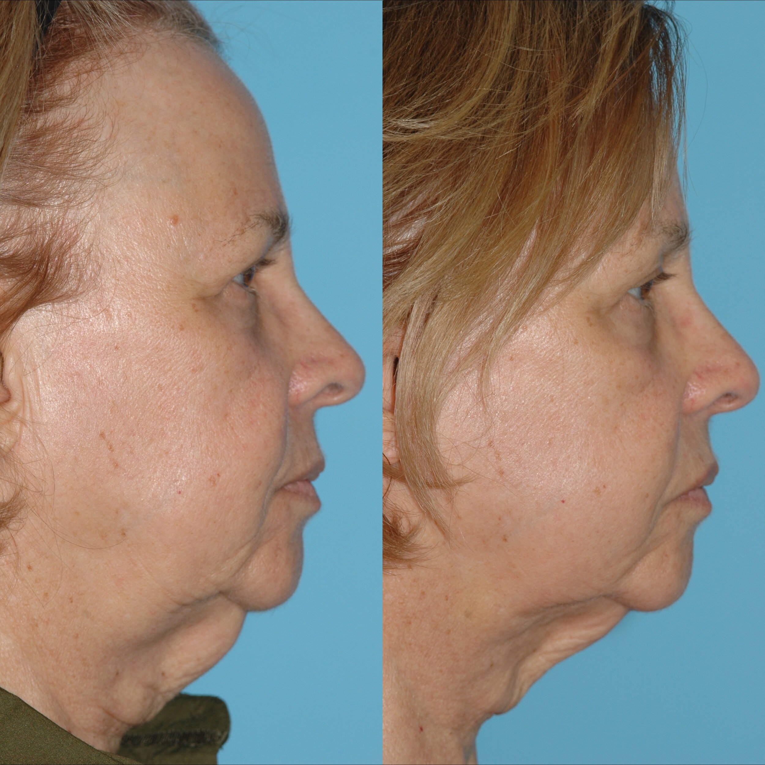  ThermiRF for minimally invasive skin tightening    