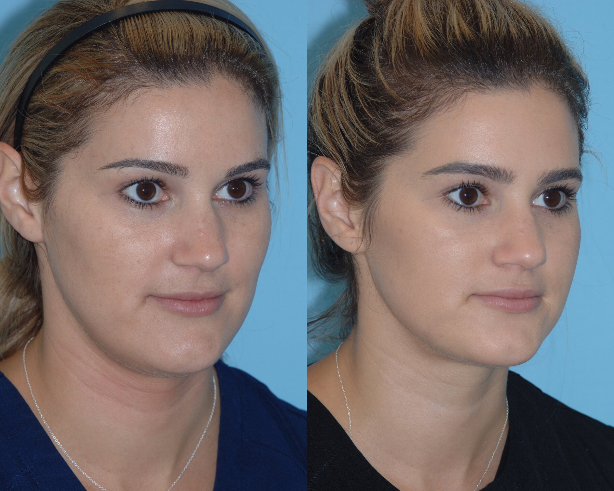  ThermiRF for minimally invasive skin tightening and submental liposuction   