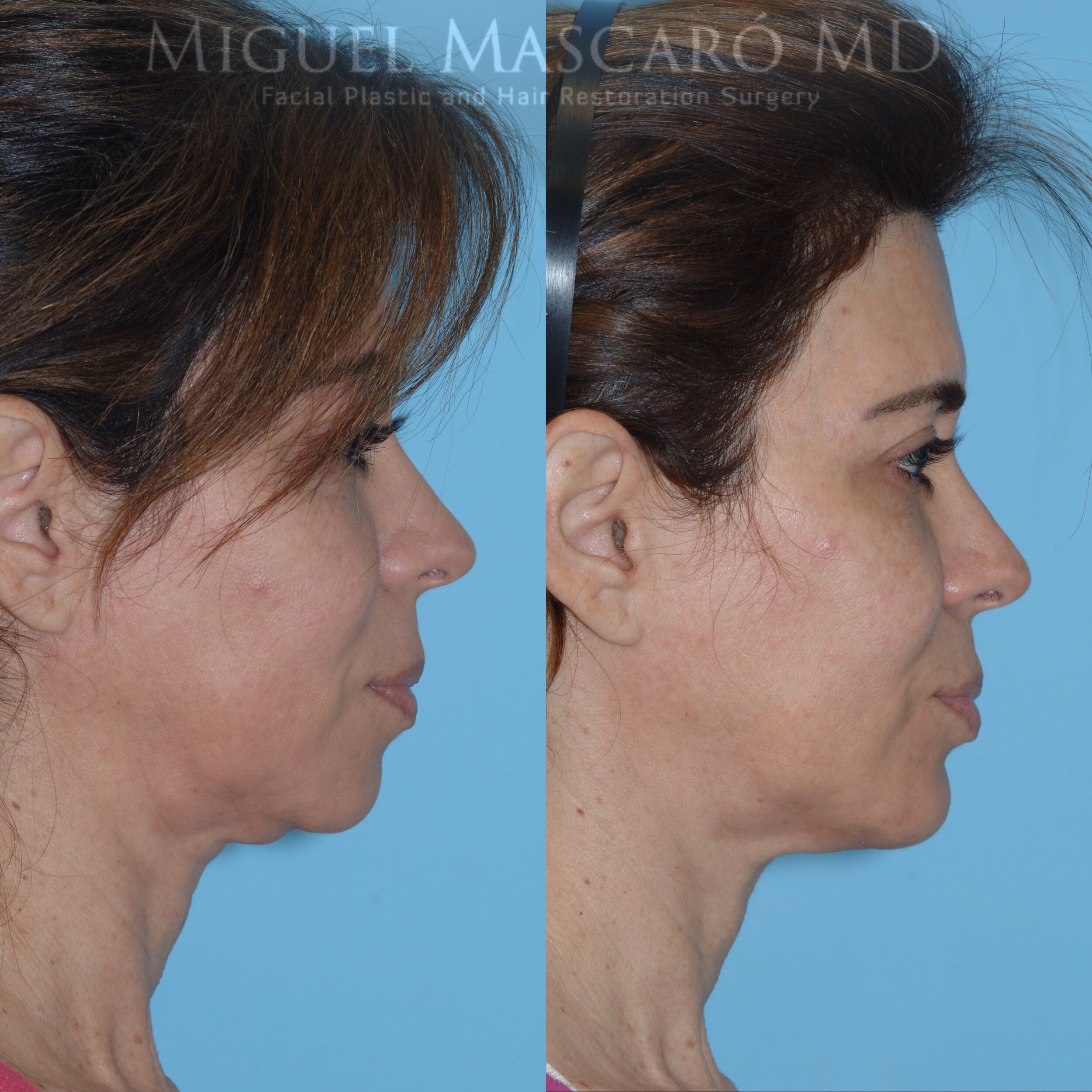  ThermiRF for minimally invasive skin tightening along jawline 