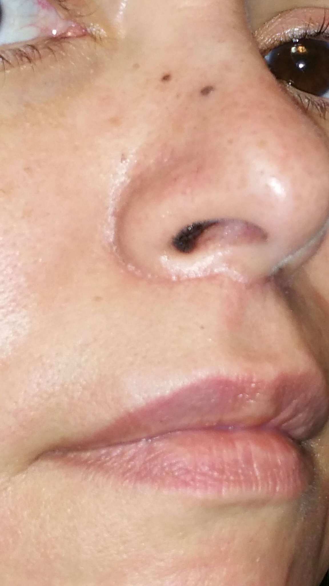  lip lift scar - ethnic skin  