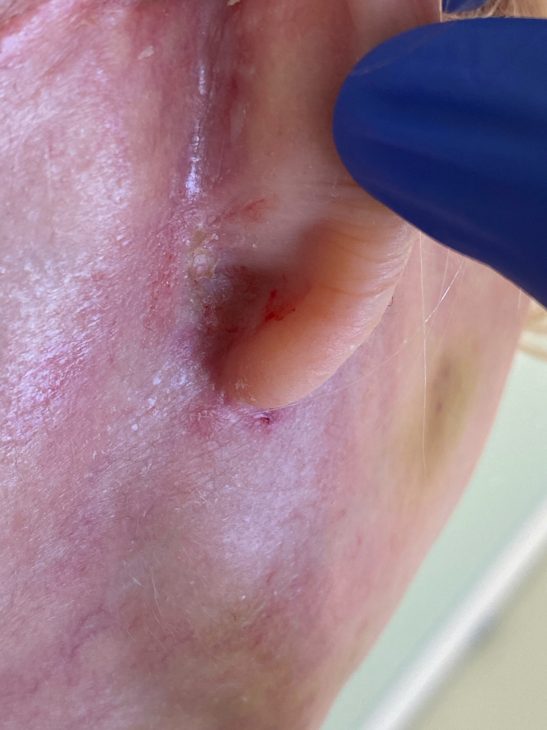  posterior ear scar from necklift  