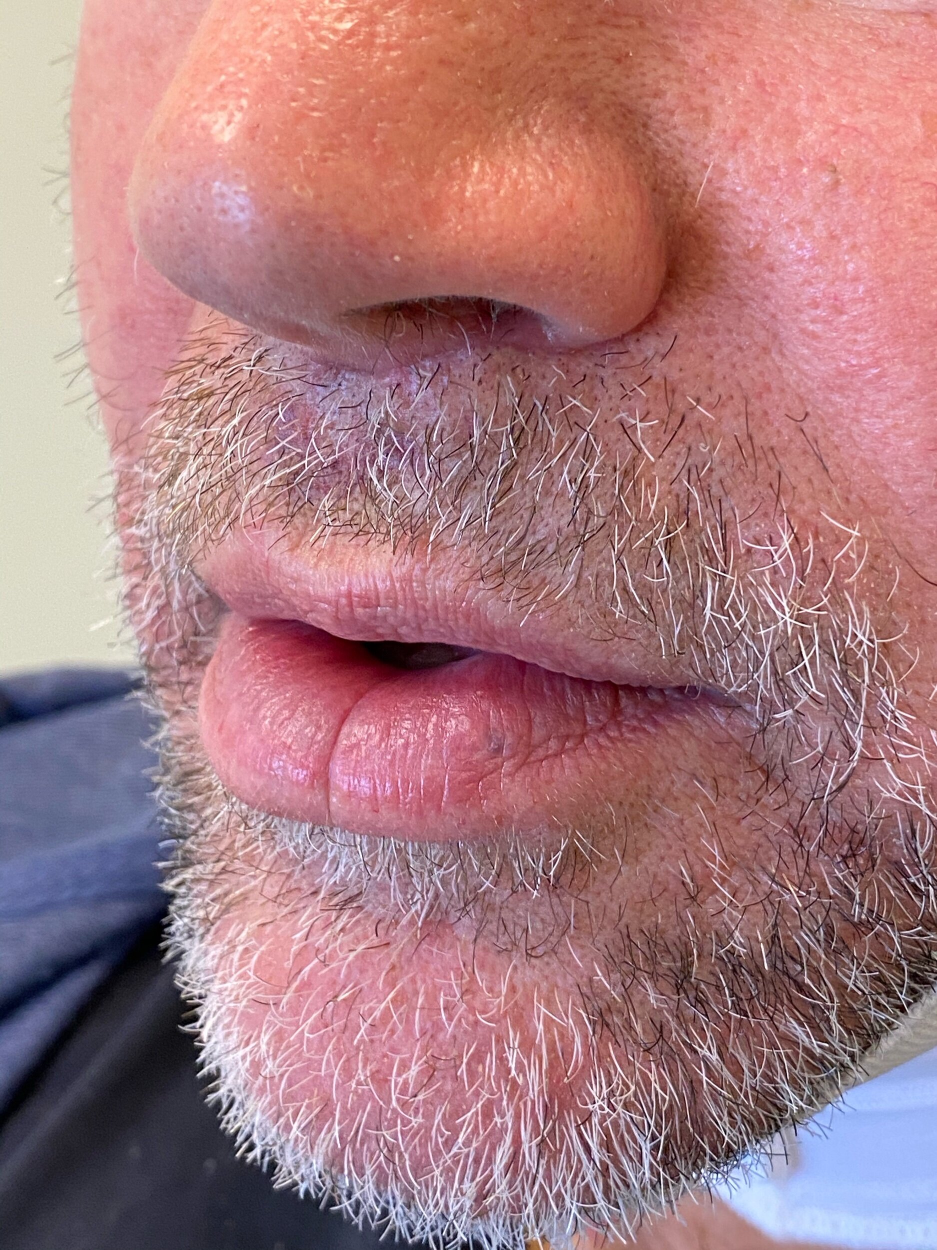  male lip lift scar  