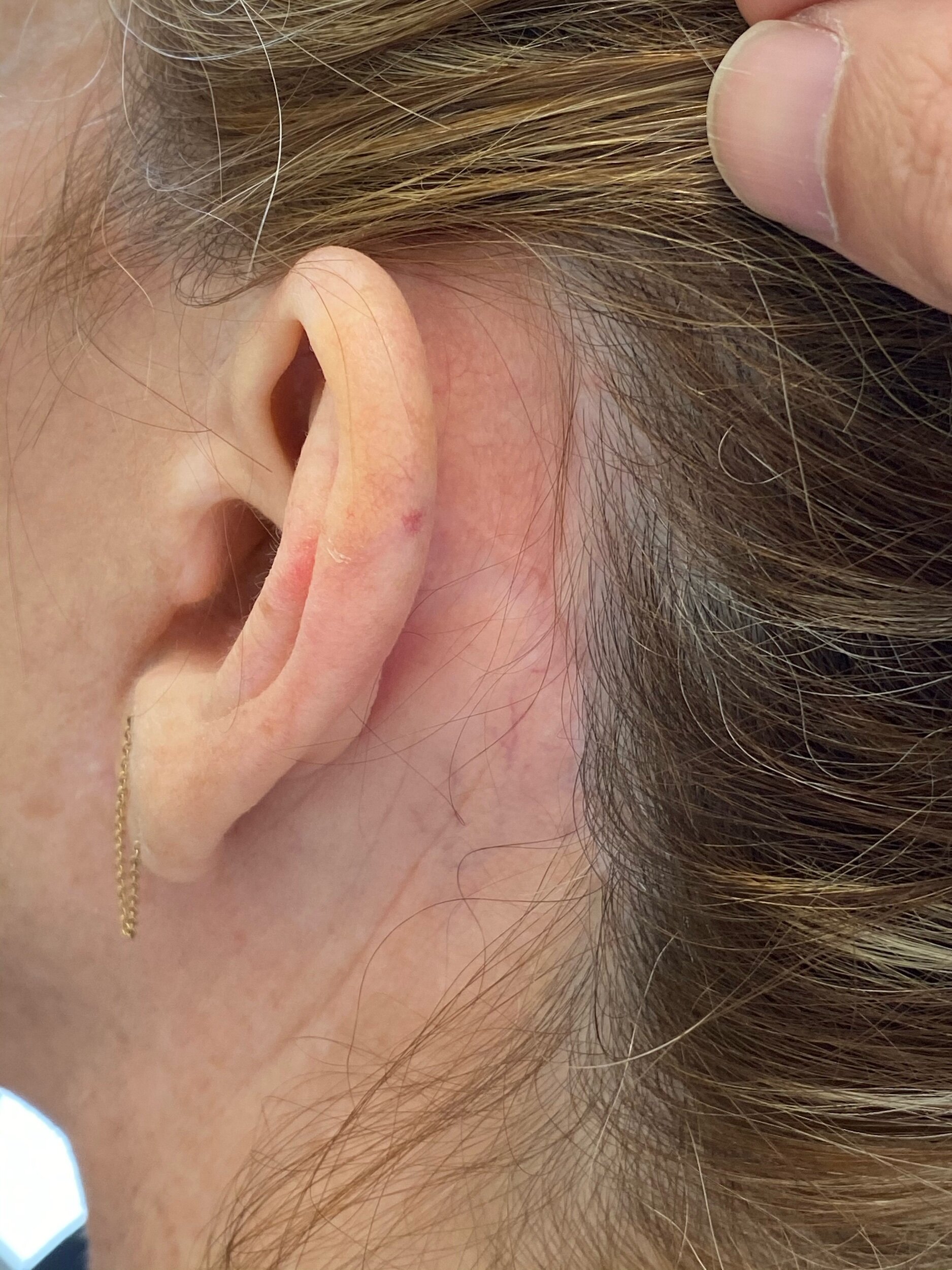  posterior ear scar from necklift  