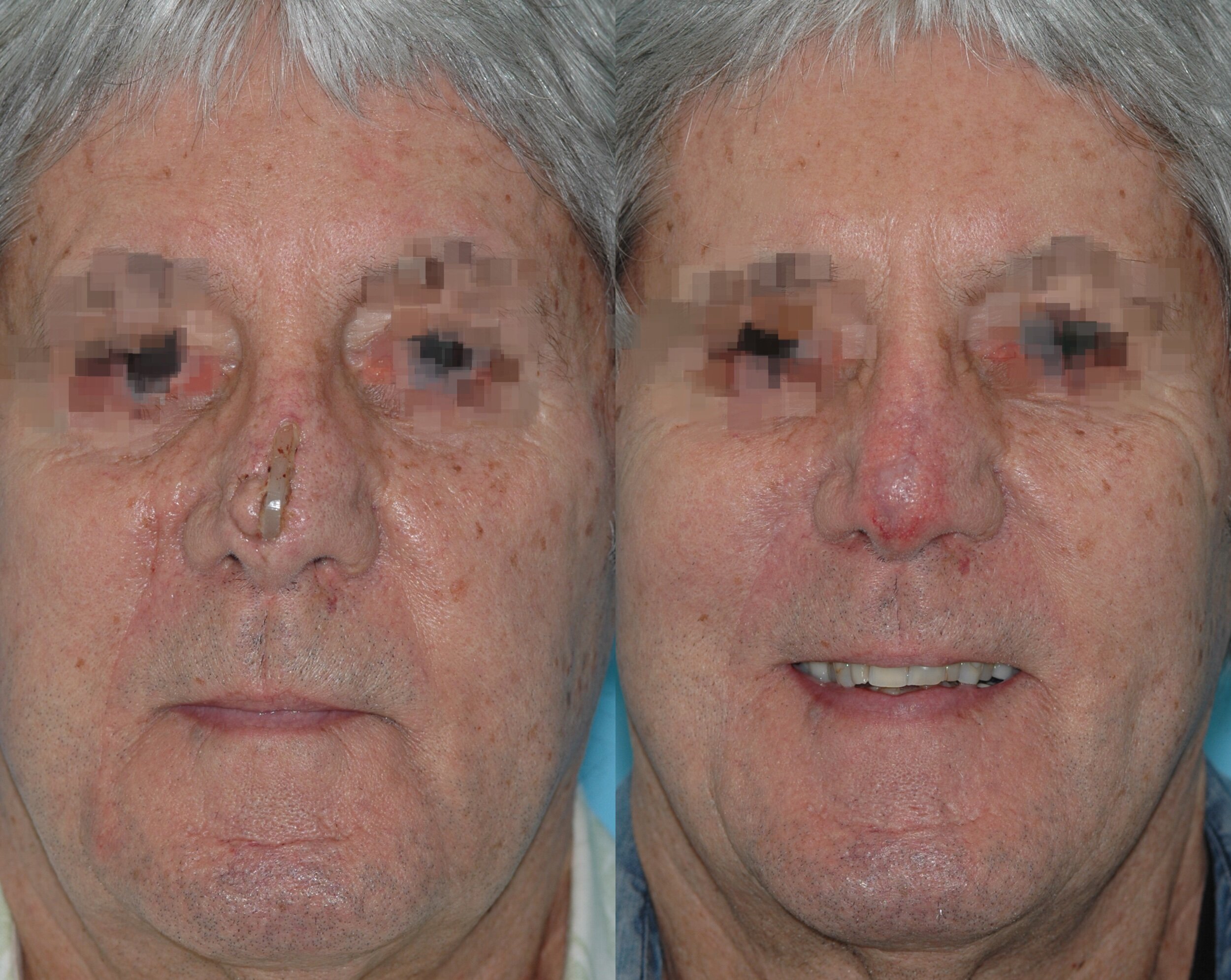  Extruding implant removal and nasal reconstruction  