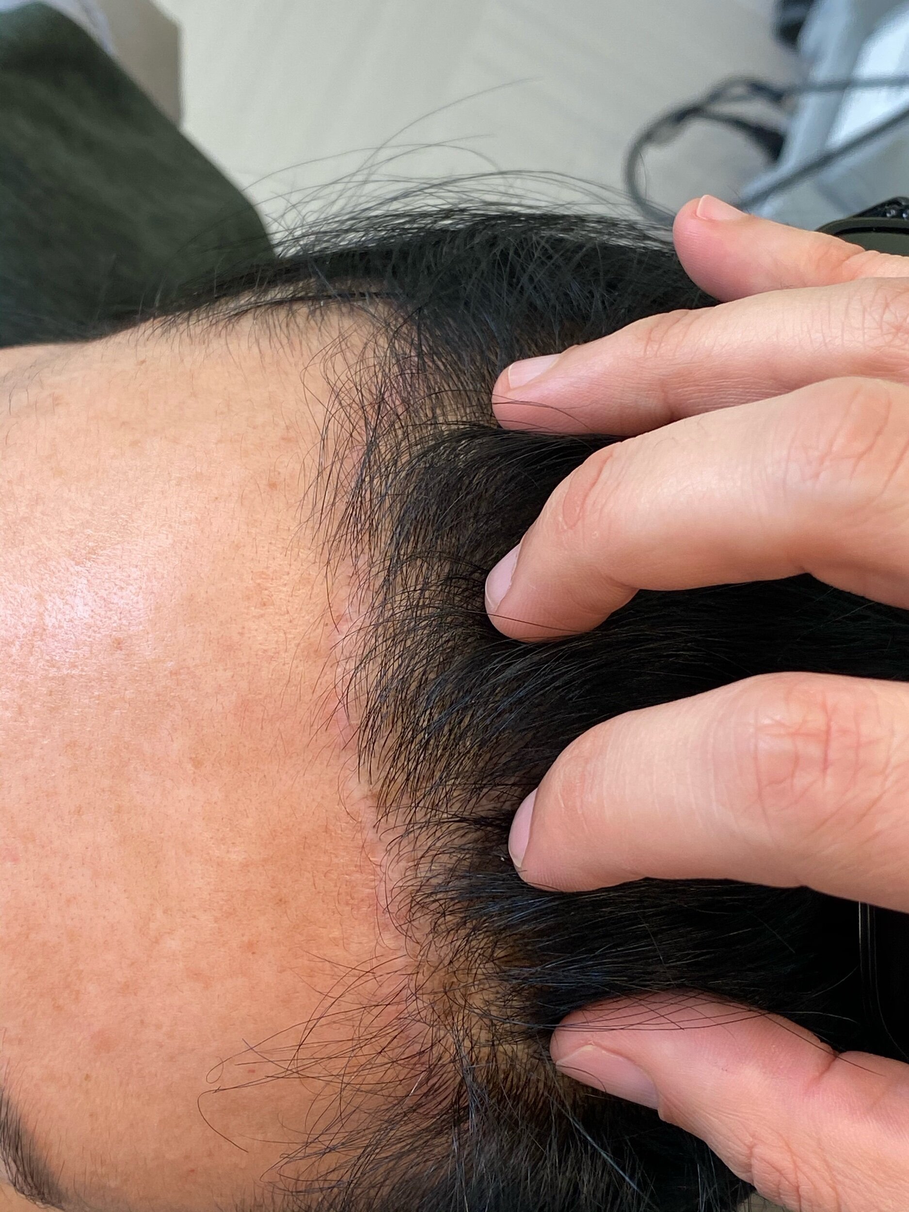  hairline advancement/forehead shortening scar 