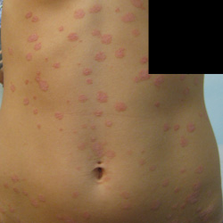 PSORIASIS | BEFORE