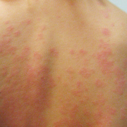 PSORIASIS | BEFORE