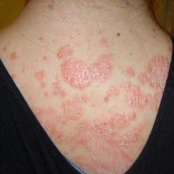 PSORIASIS | BEFORE