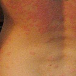 PSORIASIS | BEFORE