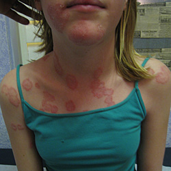 ECZEMA, RASH, FUNGAL INFECTION | BEFORE