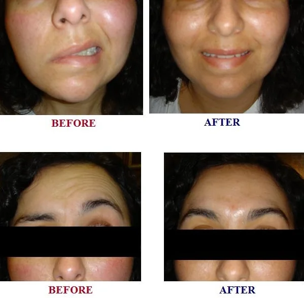 BELL'S PALSY ACUPUNCTURE AND HERBS | FACIAL PARALYSIS | NEUROLOGICAL DISORDER WITH NATURAL MEDICINE