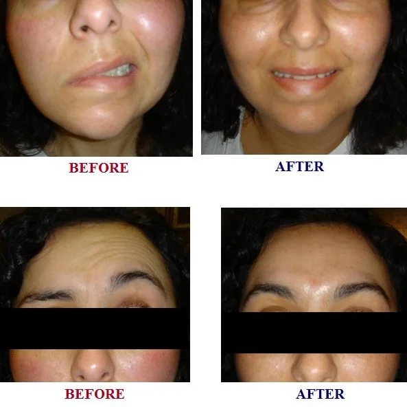 ACUPUNCTURE FOR BELL'S PALSY | NATURAL MEDICINE FOR NEUROLOGICAL DISORDERS | NATURAL HEALING FOR FACIAL PARALYSIS