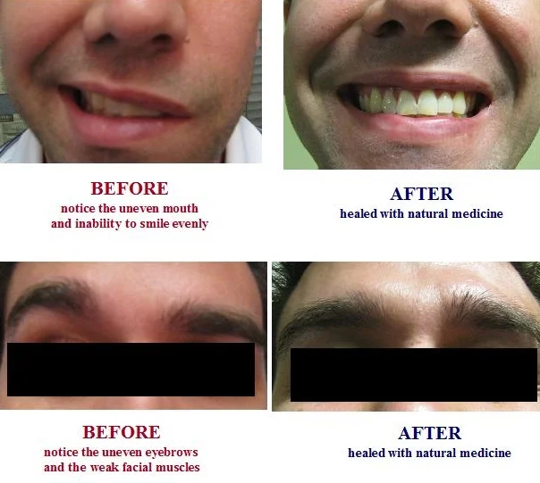 FACIAL PARALYSIS HEALED NATURALLY | ACUPUNCTURE FOR BELL'S PALSY GIVE GREAT RESULTS | NEUROLOGICAL DISORDER