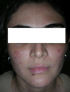 ACNE & SKIN BLEMISH | BEFORE