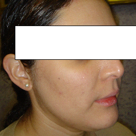 ACNE & SKIN BLEMISH | AFTER