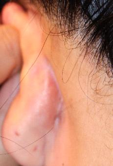 EAR CYSTS - AFTER