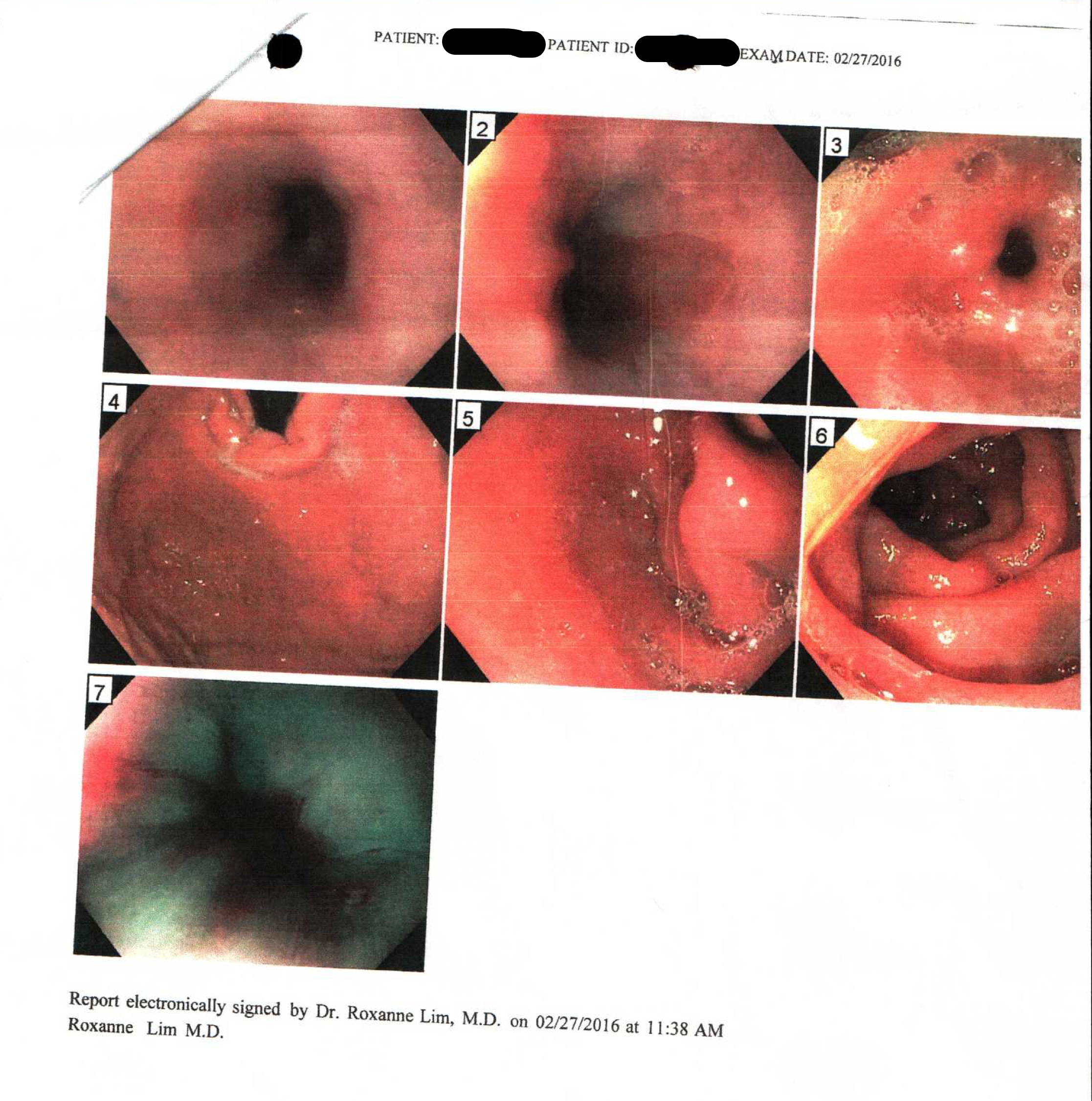 AFTER ACUPUNCTURE AND HERBS AT OUR CLINIC | UPPER GI ENDOSCOPY 2/27/2016 BY ATTENDING MD | ASTOUNDING RESULTS BY NATURAL MEDICINE