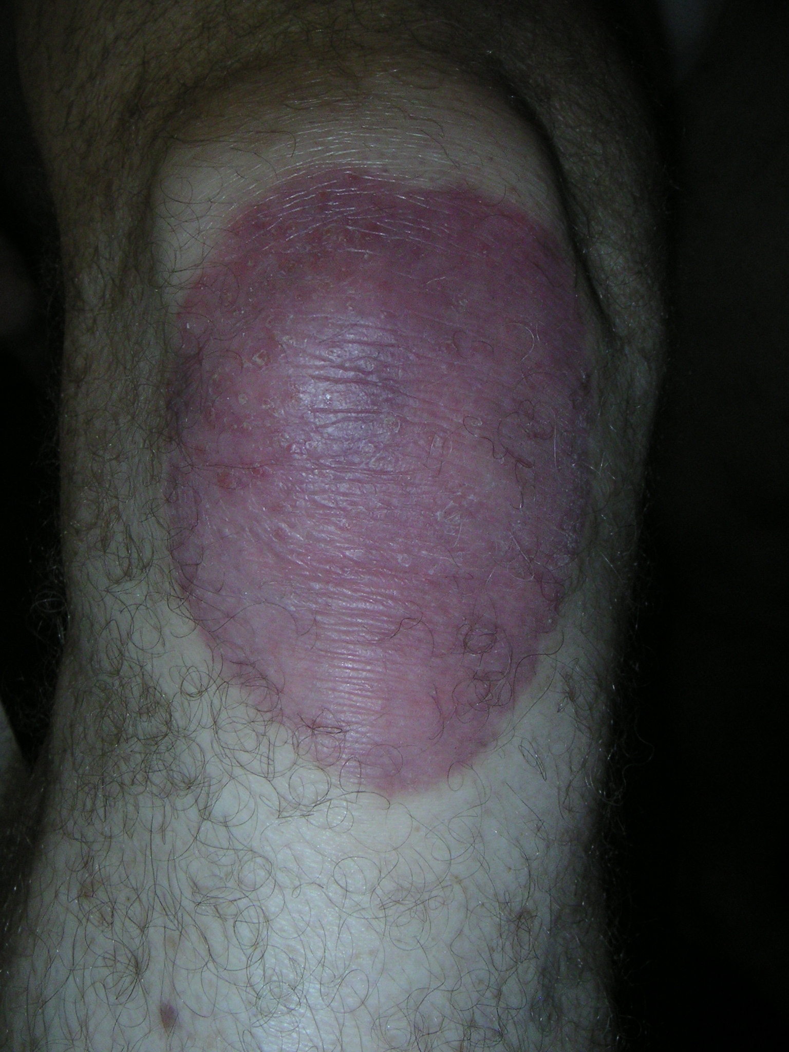 PSORIASIS RIGHT KNEE | BEFORE