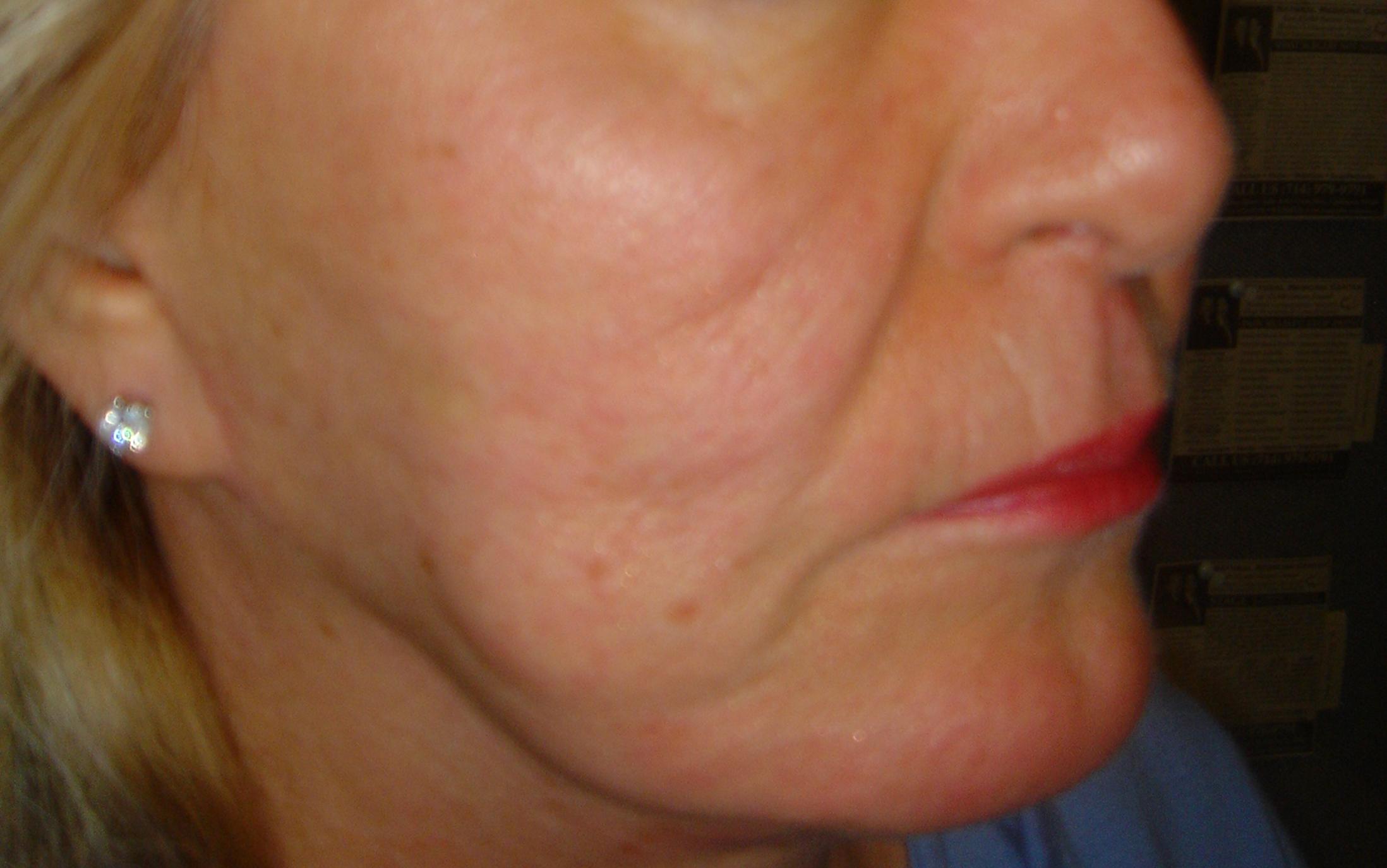 ACUPUNCTURE FACE LIFT - AFTER