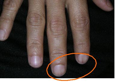 NAIL DISCOLORATION DURING CHEMOTHERAPY | BEFORE