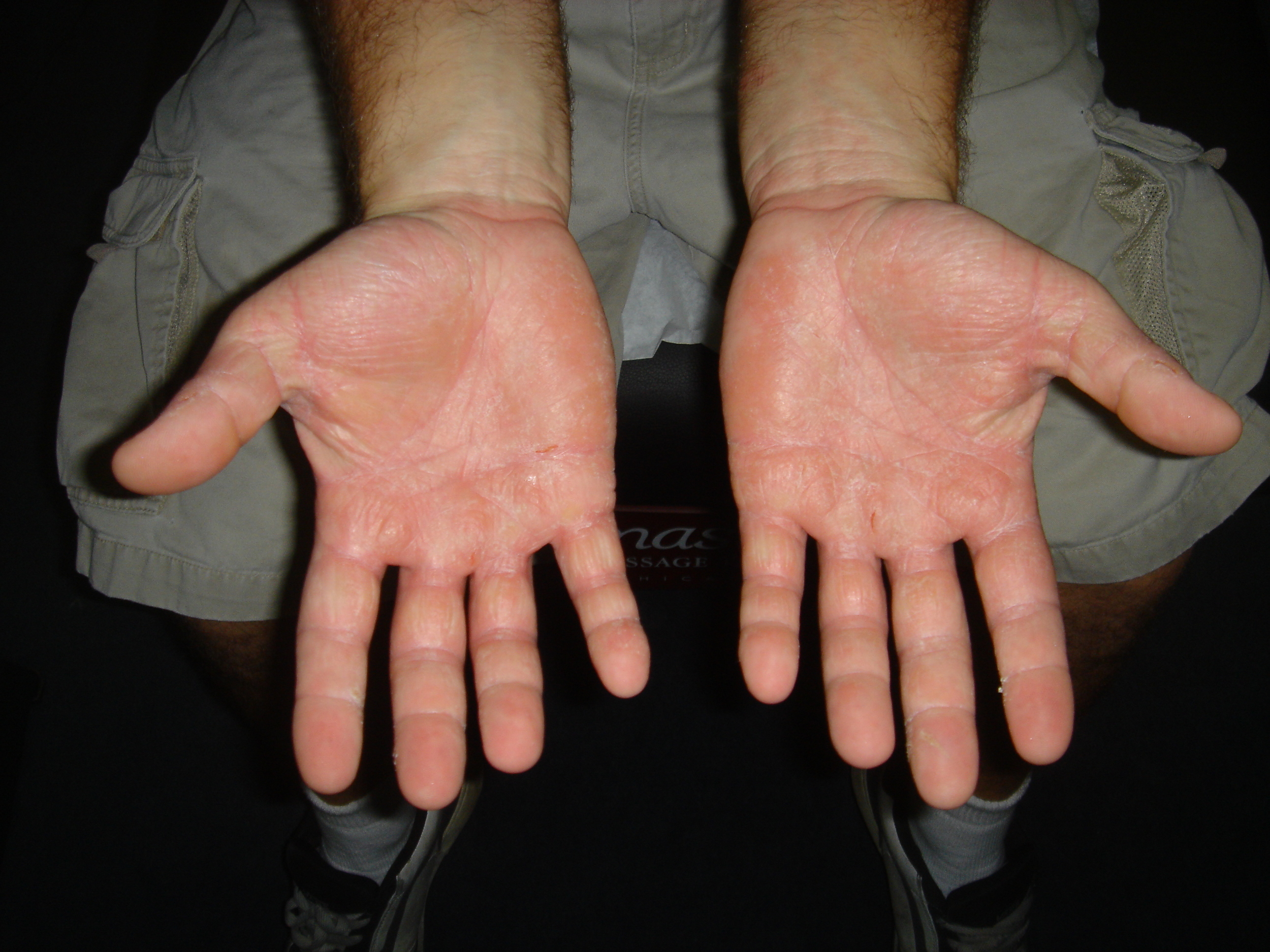 DERMATITIS SKIN CONDITION AND BLISTERS | BEFORE