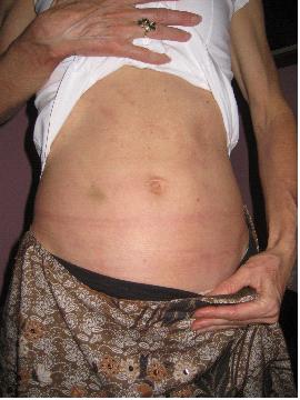 RASH ABDOMEN | AFTER