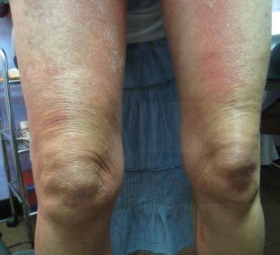 RASH LEGS | BEFORE