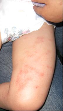 ECZEMA PEDIATRIC SKIN CONDITION | BEFORE