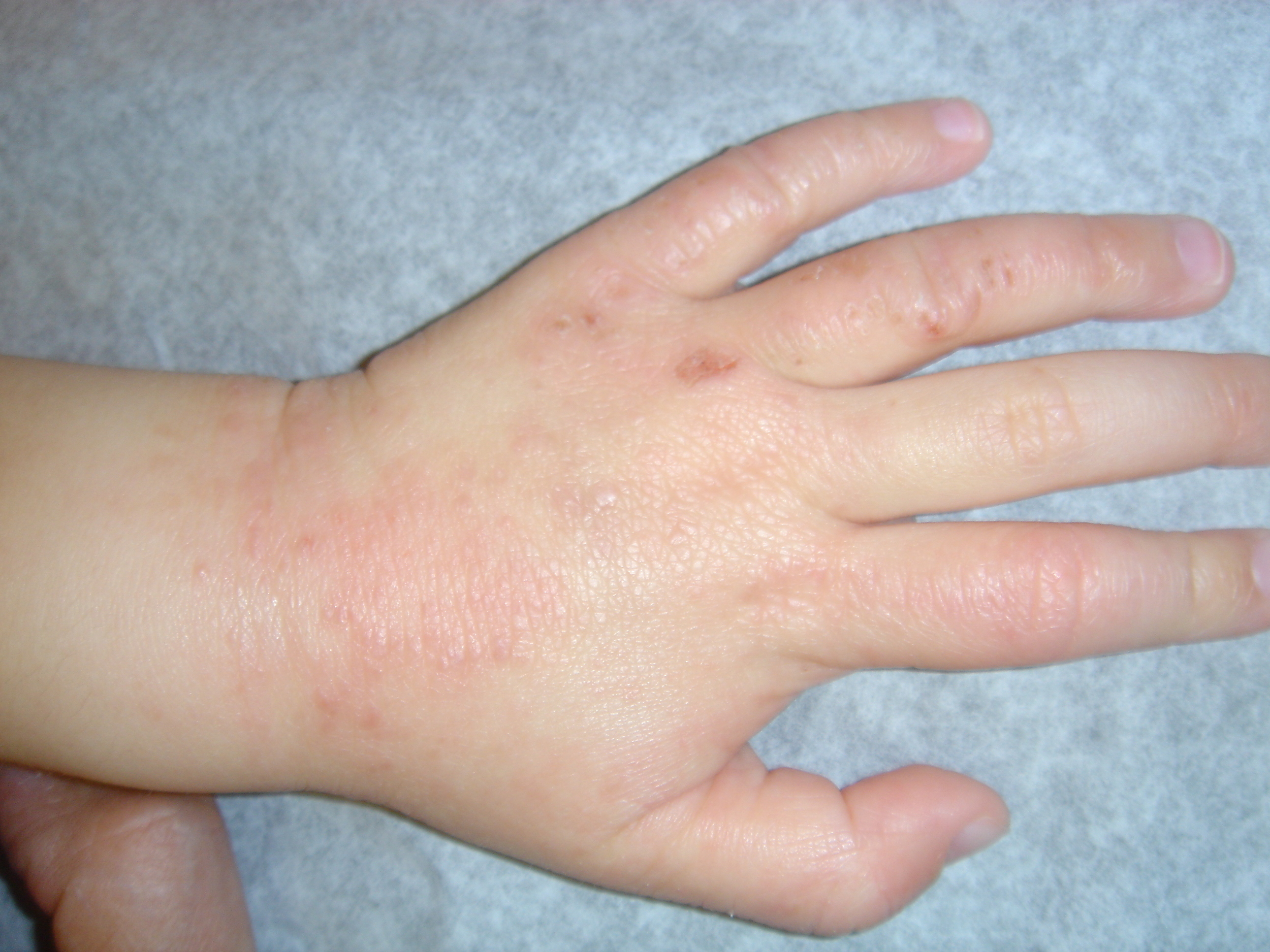 ECZEMA PEDIATRIC SKIN CONDITION | BEFORE