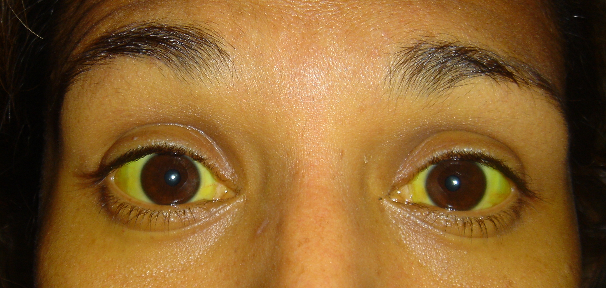 YELLOW EYES | JAUNDICE - BEFORE