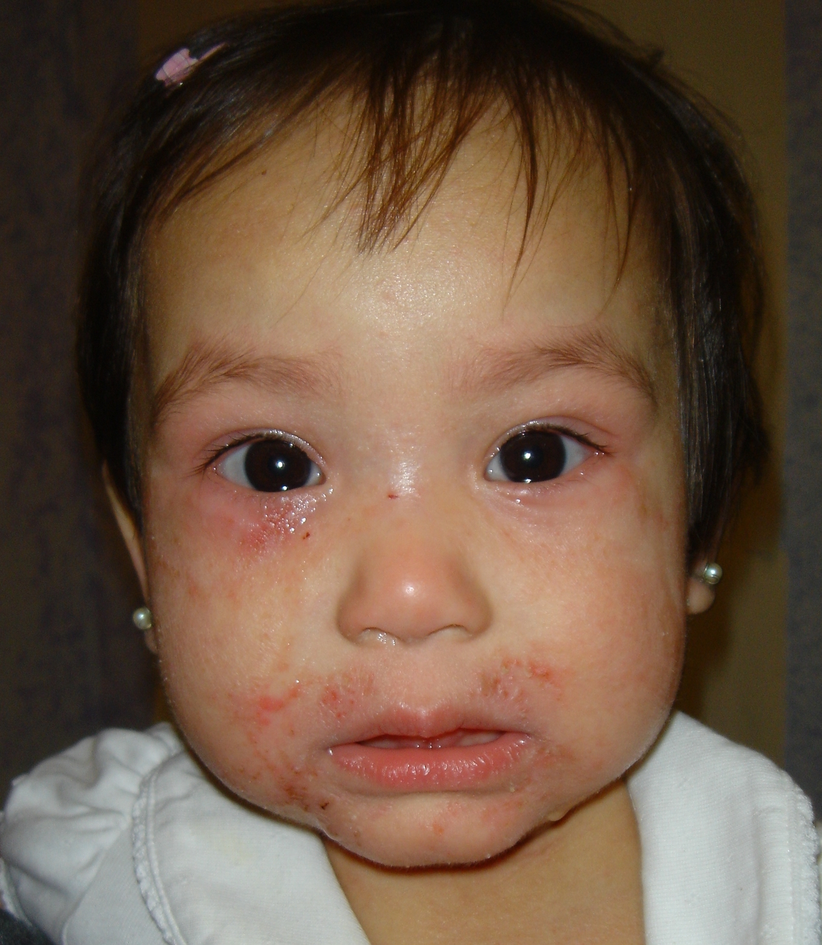 ECZEMA PEDIATRIC SKIN CONDITION | BEFORE