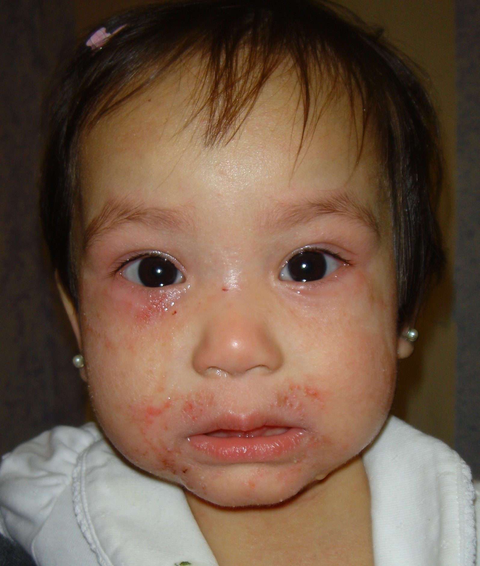 ECZEMA PEDIATRIC SKIN CONDITION | BEFORE