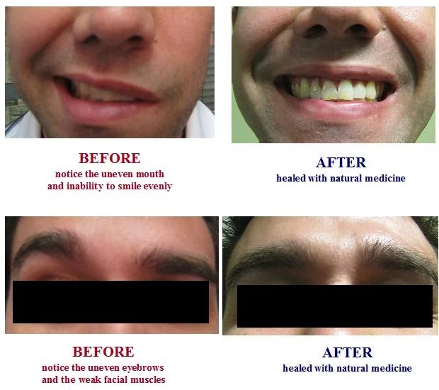 ACUPUNCTURE BELL’S PALSY | ACUPUNCTURIST BELLS PALSY | SUCCESSFUL TREATMENTS | FACIAL PARALYSIS | NATURAL MEDICINE CENTER OFFERS ACUPUNCTURE, HERBS, DIETARY SUPPLEMENTS AND NUTRITION