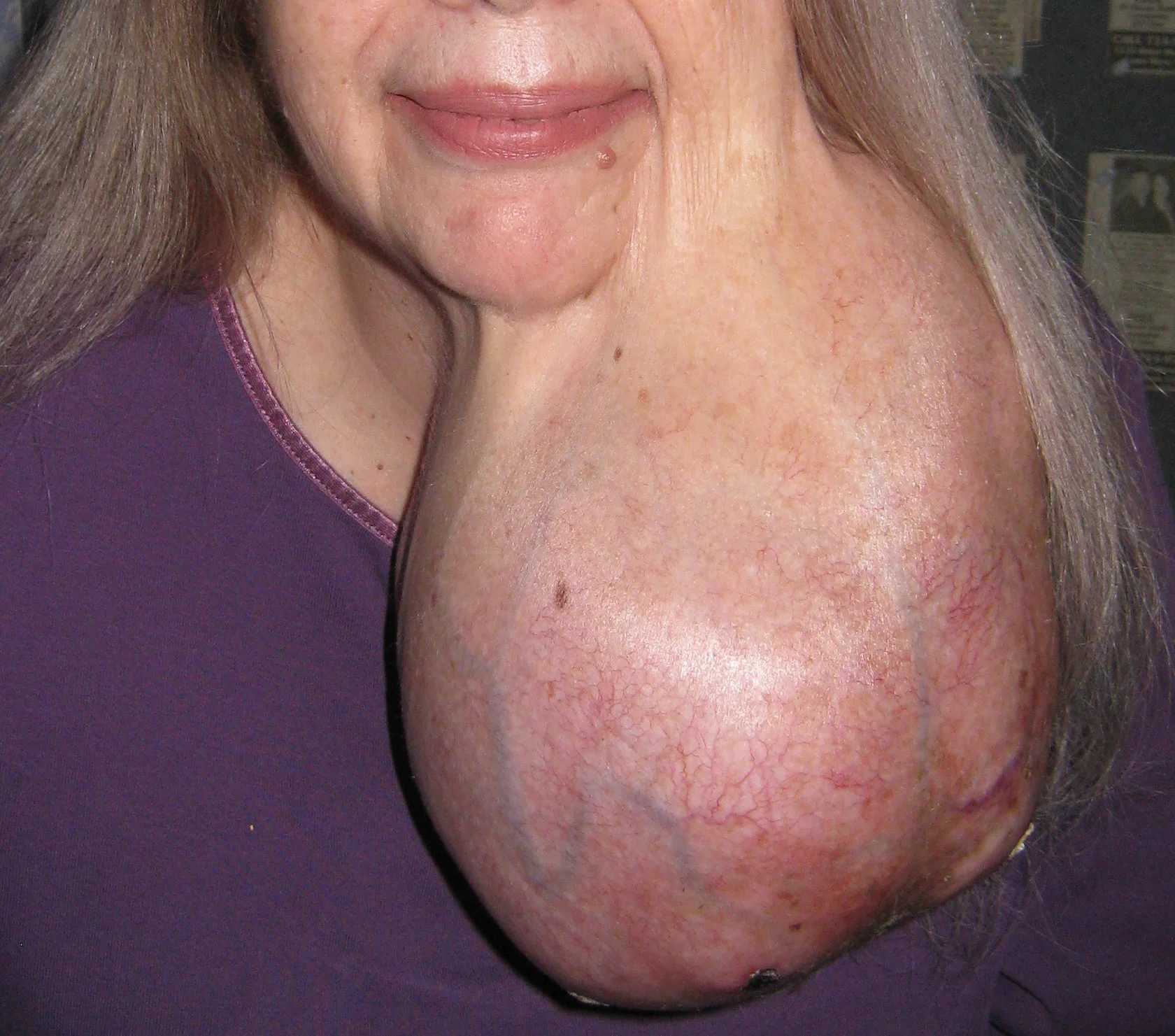 ACUPUNCTURE TUMOR | NATURAL MEDICINE HELPS PROMOTE HEALING | CANCER, TUMORS AND CYSTS | DIFFICULT DISEASES | ACUPUNCTURE TO HELP MAINTAIN AND RESTORE HEALTH