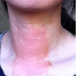 ACUPUNCTURE FOR DERMATITIS | NATURAL CREAMS FOR RASH | HERBS FOR SKIN CONDITION | PICTURE TESTIMONIAL SUCCESSFUL RESULTS