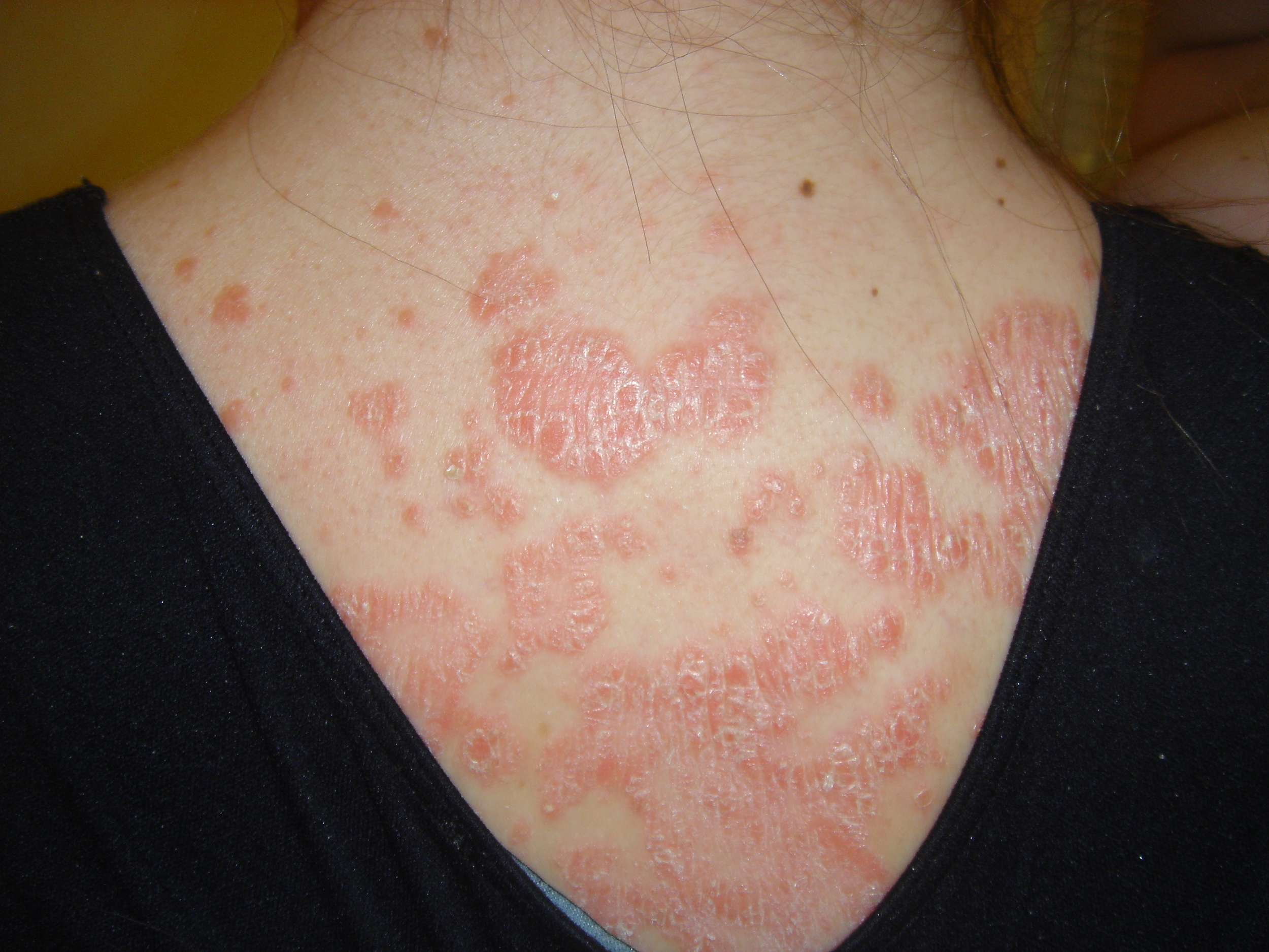 HOW IS PSORIASIS TREATED WITH ACUPUNCTURE AND HERBS? | TREATMENT OF AUTO-IMMUNE DISEASES | NATURAL MEDICINE, NUTRITION & DIETARY SUPPLEMENTS