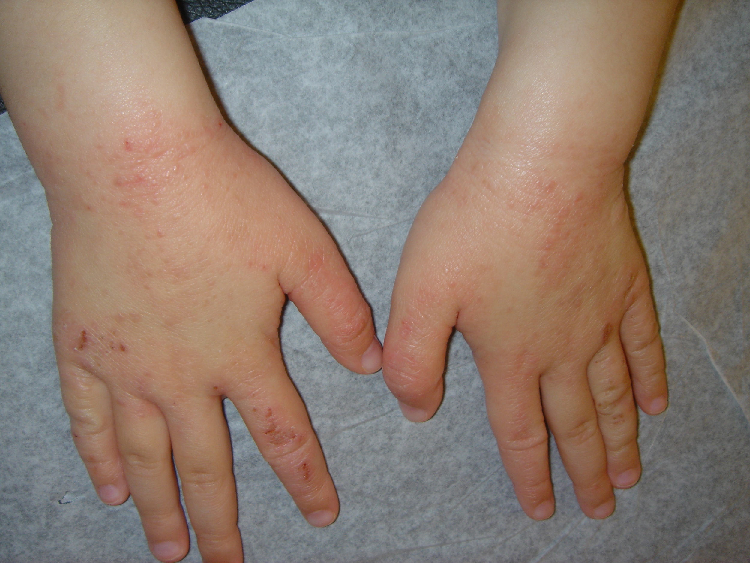 ECZEMA PEDIATRIC SKIN CONDITION | BEFORE