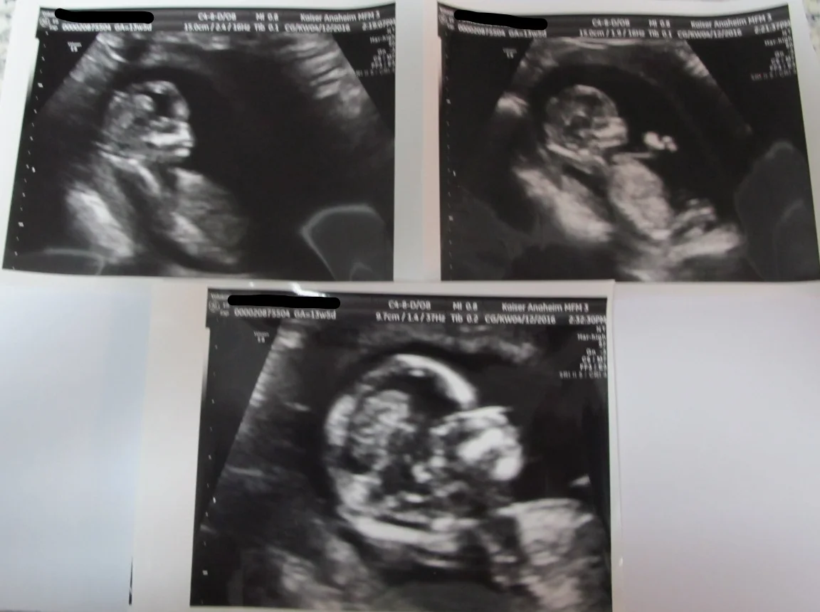 INFERTILITY | ACUPUNCTURE TREATMENTS | NATURAL PREGNANCY | BABY BOY DUE OCTOBER 2016 | DR. HUANG ACUPUNCTURIST AND HERBALIST