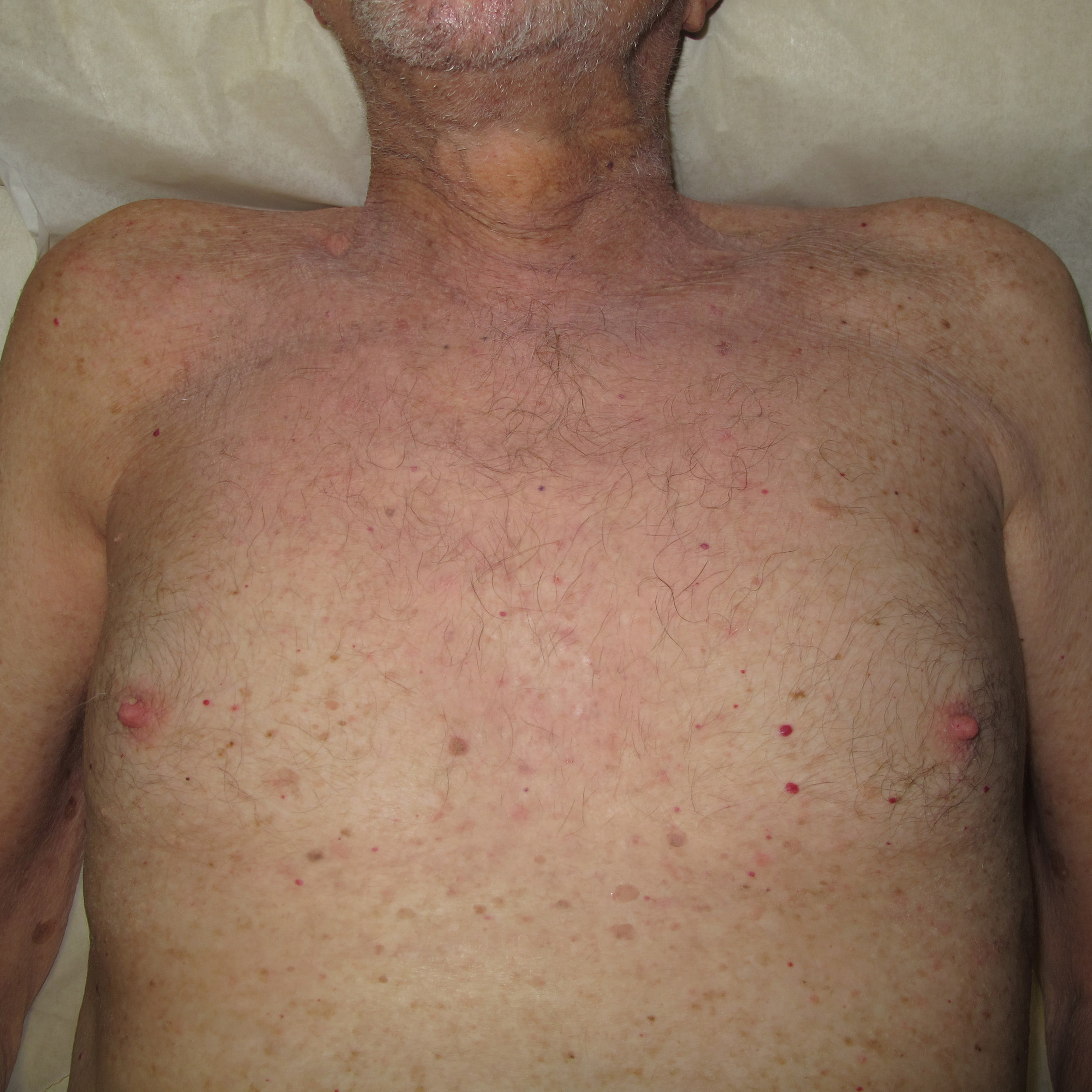 HIVES AND DERMATITIS | AFTER