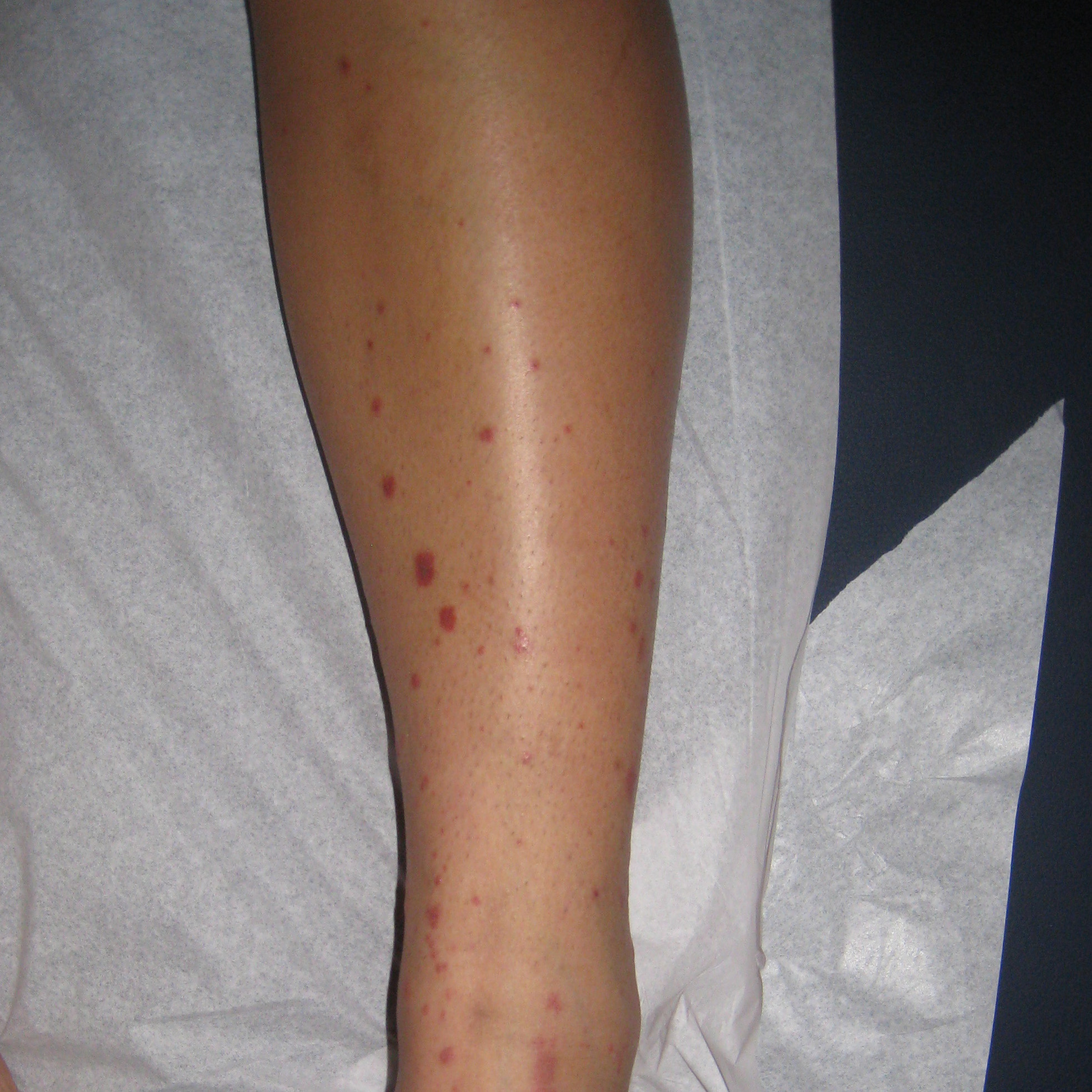 LEUKOCYTOCLASTIC VASCULITIS | BEFORE