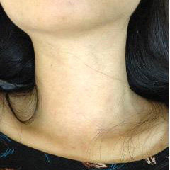 DERMATITIS | THYROID NODULES | AFTER