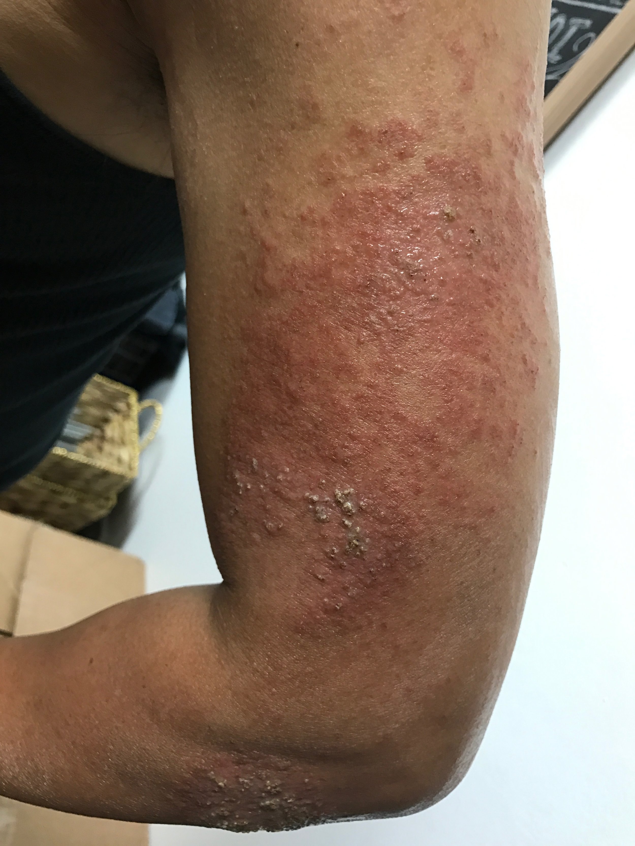 ACUPUNCTURE FOR SKIN CONDITIONS ECZEMA, PSORIASIS, URTICARIA (HIVES